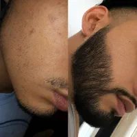 پکیج تخصصی برای رشد سریع ریش ومو