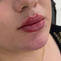 جشنواره ژل توسط پزشک برای شما عزیزان|خدمات زیبایی و سلامت|کرمانشاه, |دیوار