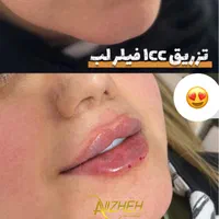 جشنواره ۳۰٪ تخفیفات ژل لب/فیلر صورت/بوتاکس/مزوژل|خدمات آرایشگری و زیبایی|مشهد, هنرستان|دیوار