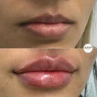 تزریق چربی و فیلربیکینی بانوان و آقایان/ساکشن چربی|خدمات آرایشگری و زیبایی|سقز, |دیوار