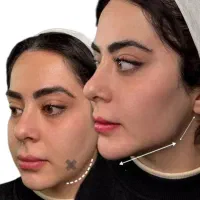 بوتاکس خالبرداری فیلر پی ارپی رفع ماه گرفتگی ضد لک|خدمات زیبایی و سلامت|مشهد, هفت تیر (حافظ)|دیوار