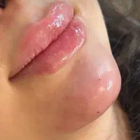 ژل وبوتاکس صورت ،بدن .پرسینگ .