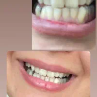 ازبین بردن جرم و پلاک دندان خوشبو کننده دهان گیاهی