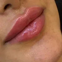 تزریق ژل وفیلر|خدمات آرایشگری و زیبایی|رباطکریم, رباطکریم|دیوار