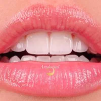 ایمپلنت، کامپوزیت، با شرایط ویژه|خدمات آرایشگری و زیبایی|تهران, فردوس|دیوار