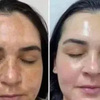 رفع سریع ملاسما و....