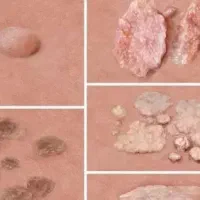 بهبودی زگیل تناسلی وhpv