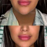 لیزرموهای زائد فول دست پا صورت ژل فیلربادی بوتاکس|خدمات آرایشگری و زیبایی|کرج, گوهردشت|دیوار