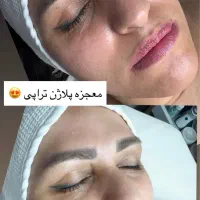 پلاژن تراپی /هایفو تراپی /لیزر بدن/کربوکسی|آرایشگاه و سالن‌های زیبایی|مشهد, کارگران|دیوار