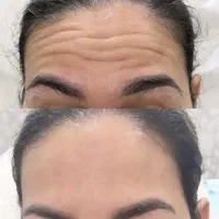 فیلر زیر چشم،ژل ،بوتاکس ،خدمات جوانسازی صورت|خدمات آرایشگری و زیبایی|اندیشه, اندیشه فاز ۱|دیوار
