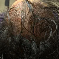 مزوتراپی و مزونیدلینگ مو درمان ریزش مو و رویش مجدد|خدمات آرایشگری و زیبایی|قائم‌شهر, |دیوار