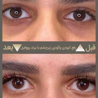 تزریق حرفه ای فیلر در کلینیک زیبایی و لیزر راویس|خدمات آرایشگری و زیبایی|کاشان, رجایی|دیوار
