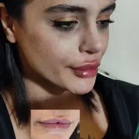 جشنواره تزریق ژل لب  و بوتاکس