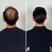 کاشت مو با خط رویش طبیعی و ضمانت نامه