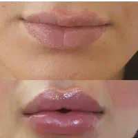 ژل و بوتاکس. مخصوص بانوان