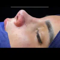 جراحی و عمل زیبایی بینی و لیپو و بلفاروپلاستی|خدمات آرایشگری و زیبایی|نسیم‌شهر, |دیوار