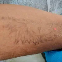 ریموو تتو مشکی و رنگی و لک|خدمات آرایشگری و زیبایی|شیراز, زرهی|دیوار