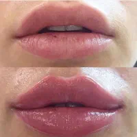 جشنواره ژل و بوتاکس و لیزر موهای زاید در نارمک