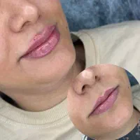 تخفیف یلدایی ژل و بوتاکس