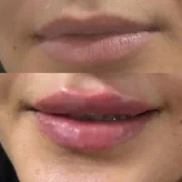 تزریق ژل سی سی 600|خدمات آرایشگری و زیبایی|پیشوا, |دیوار