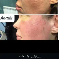 عمل بینی/لیزر co2/پلک/لیپوساکشن/غبغب|خدمات آرایشگری و زیبایی|شیراز, قصرالدشت|دیوار