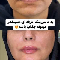 کاشت مــو/لیزر مو زائد/لاغری/فیلر بادی/ نخ بوتاکس|خدمات آرایشگری و زیبایی|شیراز, کیان شهر|دیوار
