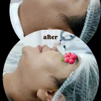 هایفوتراپی لیفت صورت /بدون جراحی/ با دستگاه ۷ بعدی