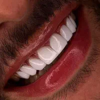 کامپوزیت دندان|خدمات آرایشگری و زیبایی|اردبیل, |دیوار