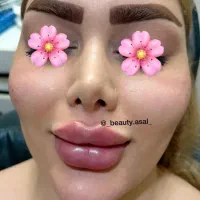 تزریق فیلر،ژل لب،فیلربینی|خدمات آرایشگری و زیبایی|شیراز, ریشمک|دیوار