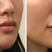 ژل بوتاکس آموزش تخصصی در مطب|خدمات آرایشگری و زیبایی|اصفهان, شهرک کاوه|دیوار