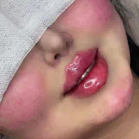 تزریقات ژل و بوتاکس|خدمات آرایشگری و زیبایی|گرگان, |دیوار