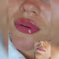جشنواره فیلر لب مرکز زیبایی صدف