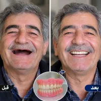 دندان مصنوعی، دست دندان،تعمیرات،دندانسازی