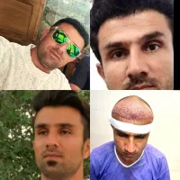 جشنواره کاشت مو به مدت محدود