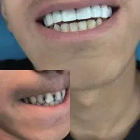 کامپوزیت دندان|خدمات آرایشگری و زیبایی|کوهدشت, |دیوار
