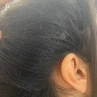 رفع شپش در ده دقیقه بدون بازگشت