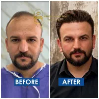 کاشت مو / کاشت ابرو / کاشت ریش سبیل
