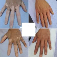 تتو پزشکی ویتیلیگو برص. تغییررنگ بخیه.طراحی نیپل )