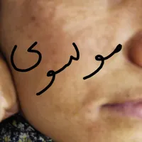روشن کننده وضدلک درمانی جوابدهی صدرصدی وتضمینی|حراج|لردگان, |دیوار
