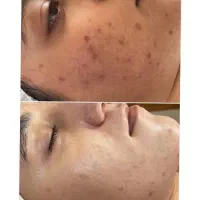 تخفیفات باورنکردنی کلینیک تخصصی پوست(پاکسازی فشیال