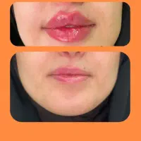 اف  انواع تزریق ژل باکمترین قیمت پاک کردن ابرو