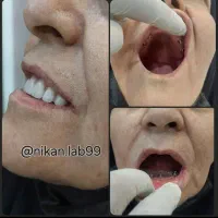 دندانسازی دندان مصنوعی تحویل ۲روزه باضمانت|خدمات آرایشگری و زیبایی|اصفهان, کشاورزی|دیوار