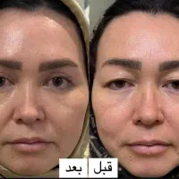 بوتاکس فیلر بلفاروپلاسی تزریق چربی نخ لیفت فشیال|خدمات آرایشگری و زیبایی|اصفهان, ملک‌شهر|دیوار