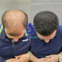 نژا کاشت مجموعه تخصصی کاشت مو از سال 1383