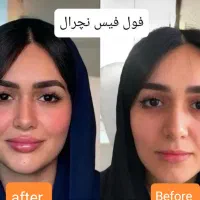 جشنواره/فیلر/بوتاکس/آنزیم/تخفیف دکترفیروزی|خدمات آرایشگری و زیبایی|شیراز, زرهی|دیوار