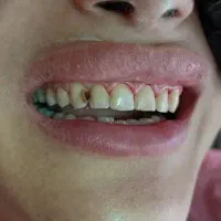 کامپوزیت زیبایی آف