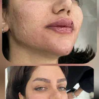 تخفیفات تکرارنشدنی ژل وبوتاکس درمطب پزشک