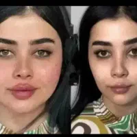 زاویه سازی.ژل.فیلر.نخ.انزیم مزو بوتاکس دکتر داریوش|خدمات زیبایی و سلامت|مشهد, گوهرشاد|دیوار