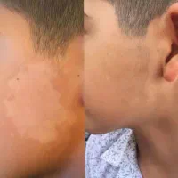 درمان مشکلات پیسی و پسوریازیس