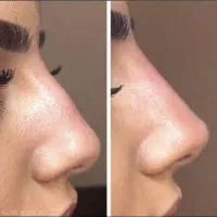 ژل/فیلر/فیشیال/پاکسازی/پوست ومولیزر|خدمات آرایشگری و زیبایی|کرج, گوهردشت|دیوار